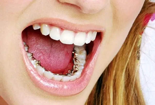 tabela de preços de prótese dentária 2022