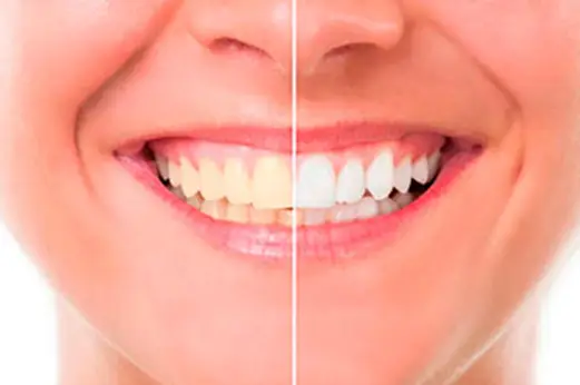 amil dental prótese dentária fixa 2024