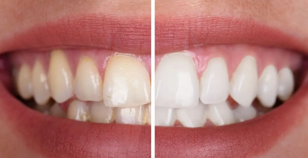 Valor lente de contato dental preço 2023