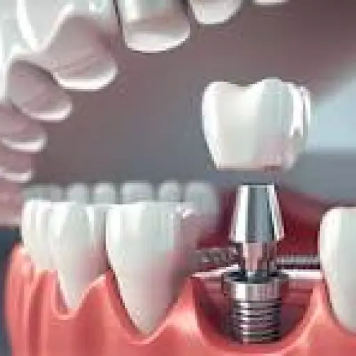 Prótese Dentária Fixa 2025